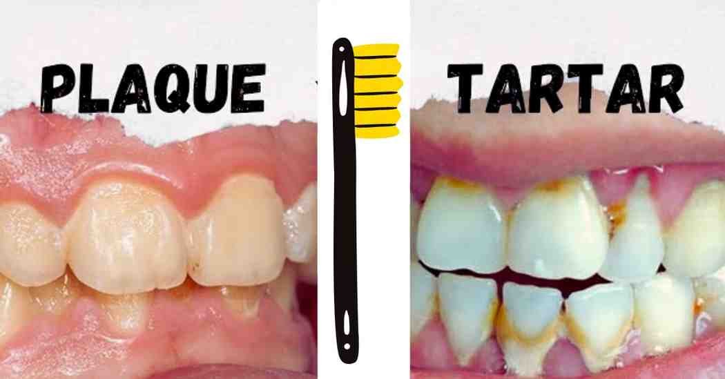 Natural Ways to Remove Plaque and Tartar From Teeth