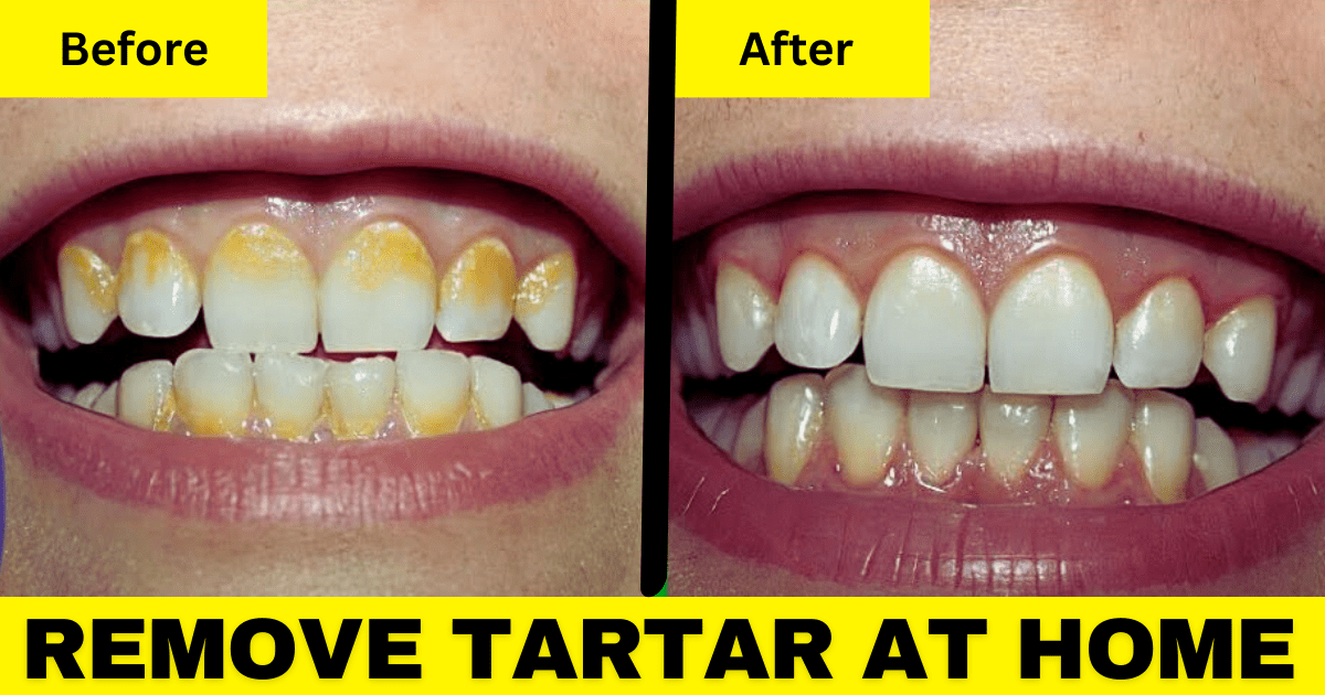 Remove Tartar at Home